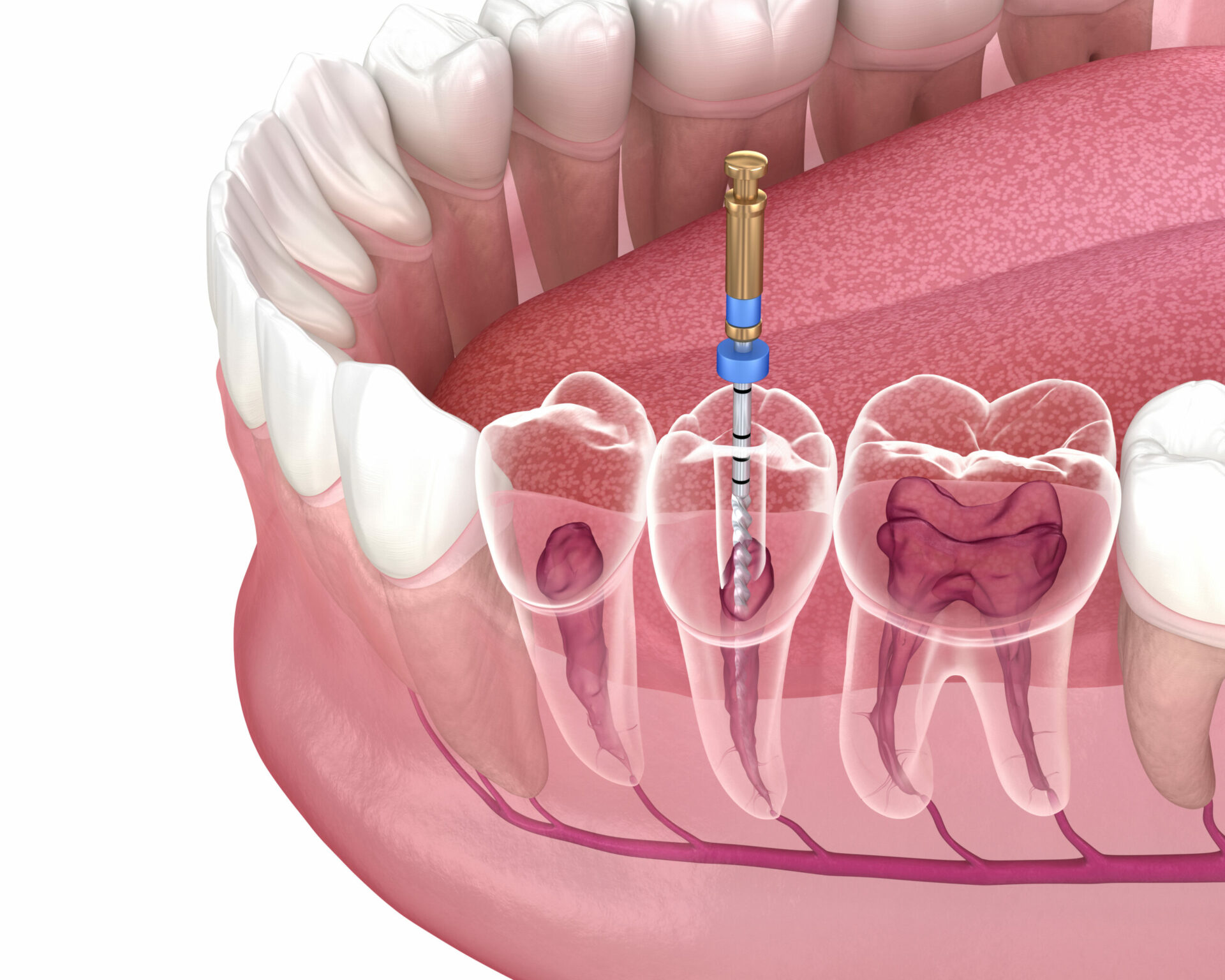 All You Need to Know About Root Canal Treatment